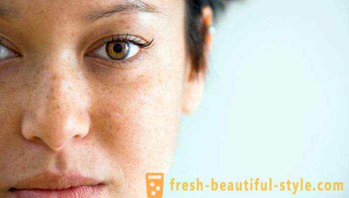 Brune flekker i ansiktet: årsakene til og behandlinger. brune flekker