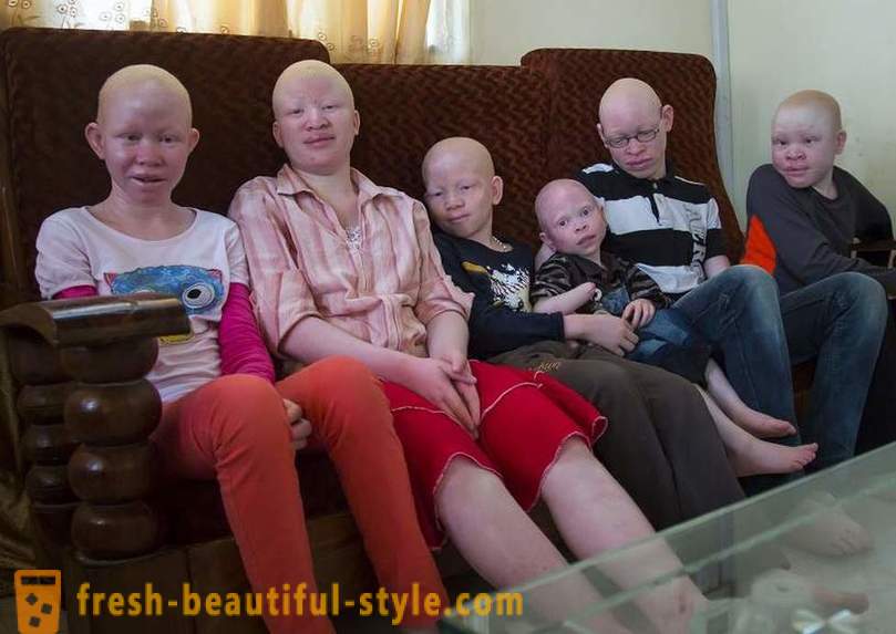 Den tragiske historien om tanzaniansk albinos