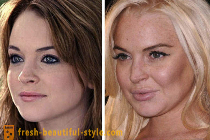 15 kjendiser, ferdig dårlig med Botox