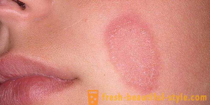 Skjellende hud i ansiktet og hendene: mulige årsaker og funksjoner for omsorg