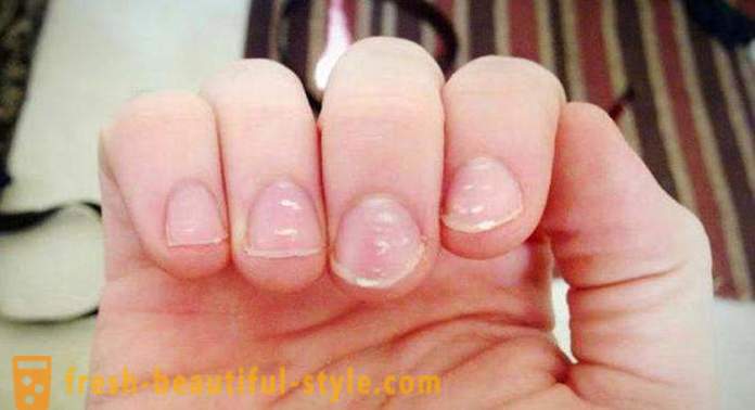 Hvite flekker på neglene på fingrene: årsakene til og behandling