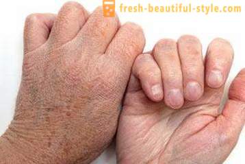 Tørr hud på hendene: Forårsaker. Veldig tørr hud, hva gjør jeg?