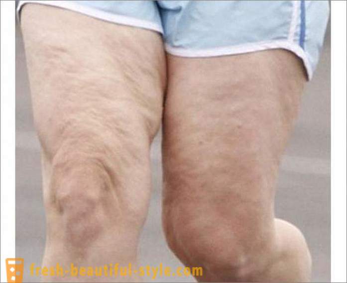 Hvordan bli kvitt cellulitter på bena? Øvelser for benene på cellulitt