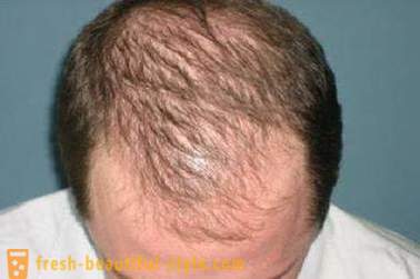 Hvordan akselerere veksten av hår på hodet? Restaurering av hårvekst
