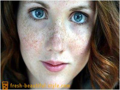 Ta vare på sin skjønnhet og ungdom: forårsaker pigmentering i ansiktet
