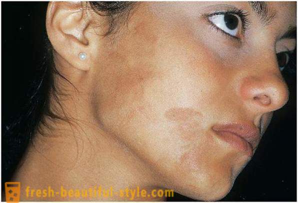 Ta vare på sin skjønnhet og ungdom: forårsaker pigmentering i ansiktet
